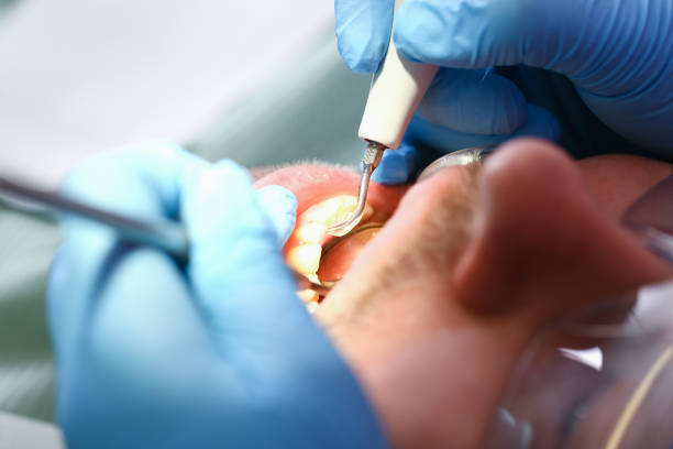 Best Emergency Root Canal Treatment in Estes Park, CO